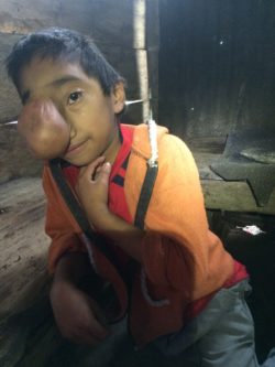 Daniel, one of the boys in Chicaman, Guatemala, had a growth protruded the size of a plum